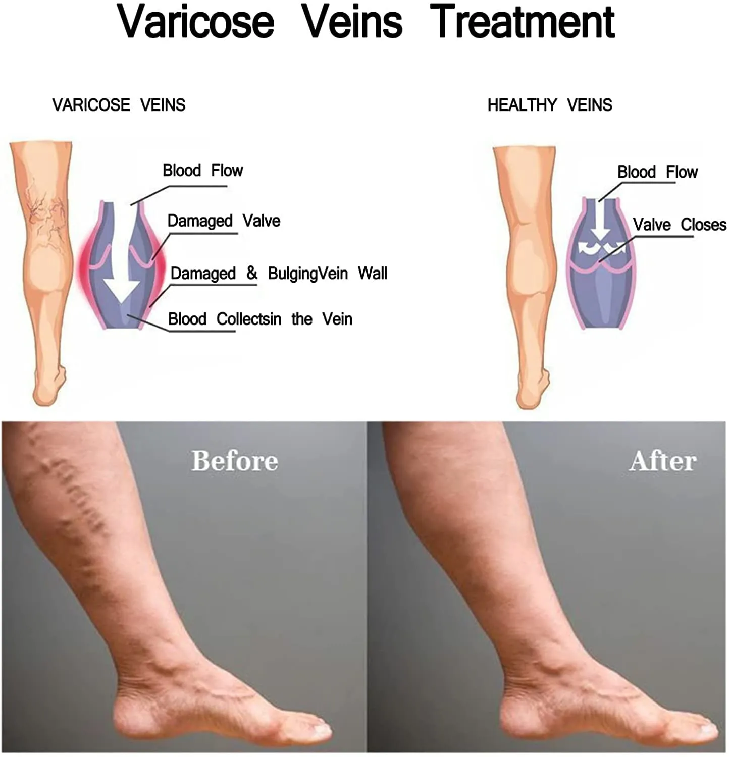 2PCS 30ML Varicose Treatment Spray, Herbal Vein Healing Varicose Veins Soothing Spray,Varicose Veins Miracle Spray,Varicose Veins Cream Improves Micro-Circulation A