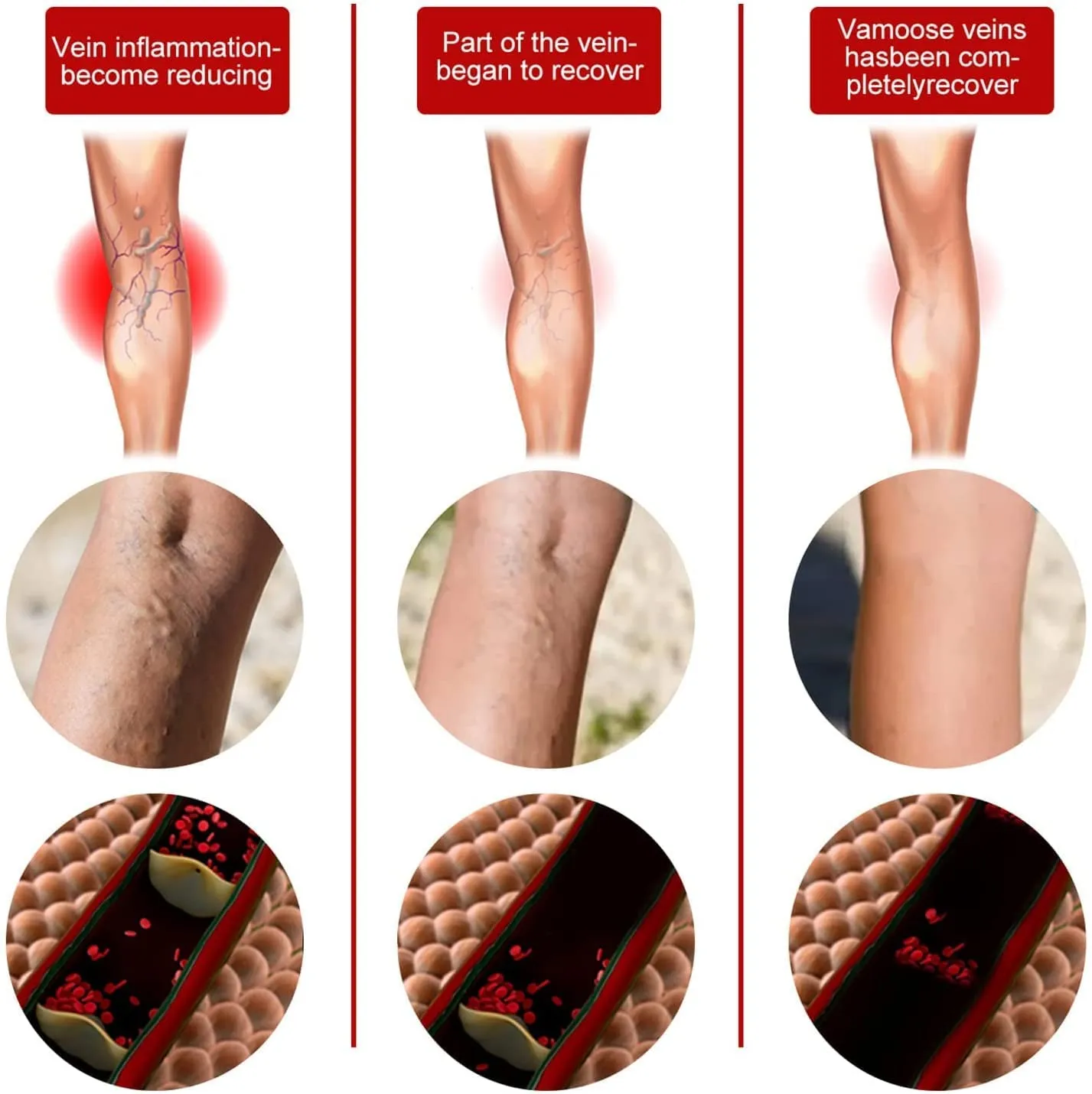 2PCS 30ML Varicose Treatment Spray, Herbal Vein Healing Varicose Veins Soothing Spray,Varicose Veins Miracle Spray,Varicose Veins Cream Improves Micro-Circulation A